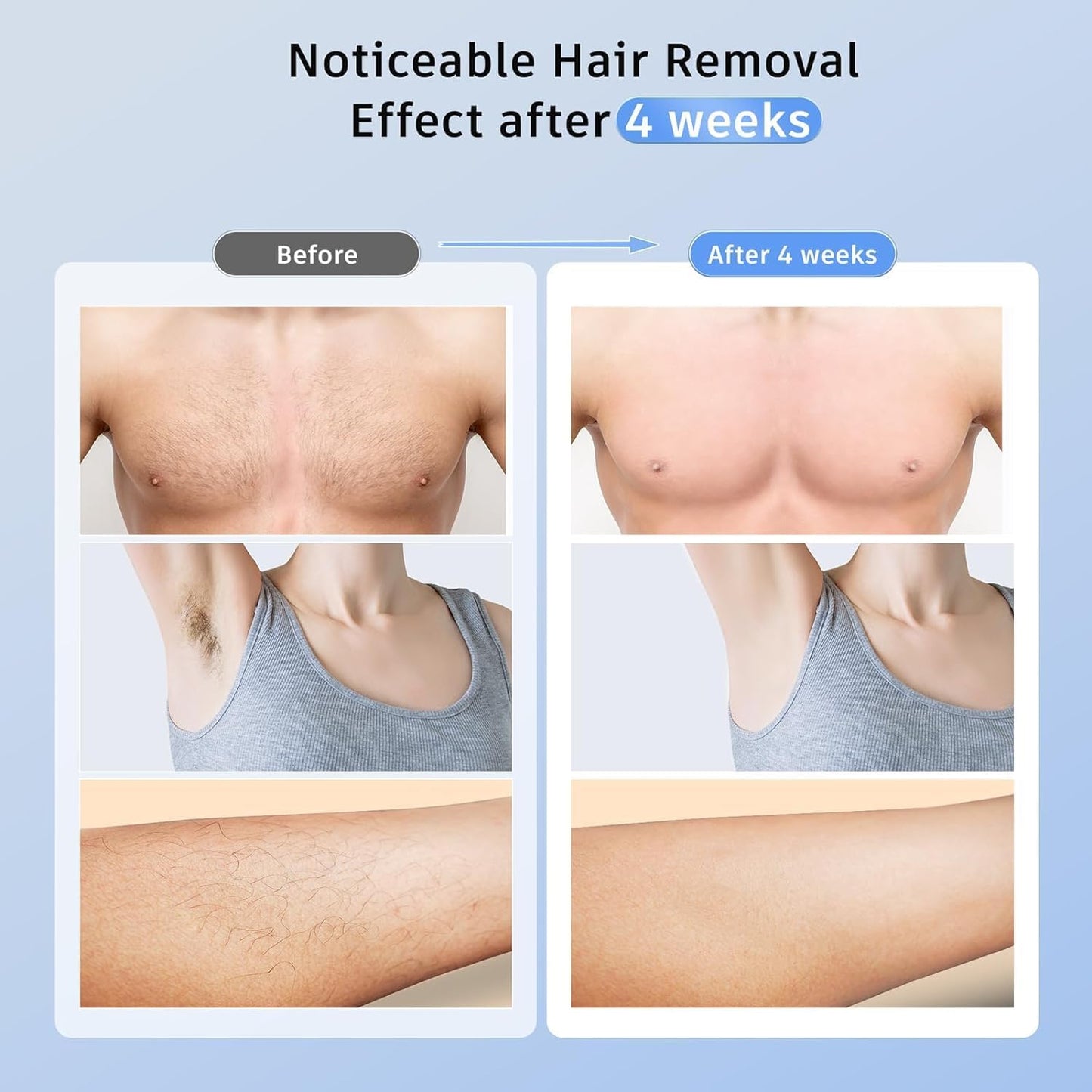 Laser Hair Removal Ubroo IPL Hair Removal Device with 5℃ Ice Cooling,Painless Laser Hair Removal for Women and Men,Full Body Use for Legs,Bikini,Armpits (Blue)